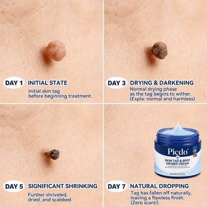 𝐏𝐢𝐜𝐝𝐨®🩹7-𝐃𝐚𝐲 𝐒𝐤𝐢𝐧 𝐓𝐚𝐠 & 𝐒𝐩𝐨𝐭 𝐄𝐫𝐚𝐬𝐞𝐫 𝐂𝐫𝐞𝐚𝐦(Zero Pain, Zero 𝐒𝐜𝐚𝐫𝐬 Formula)💪